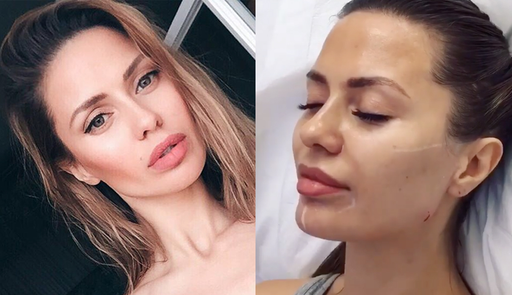 permanent fillers